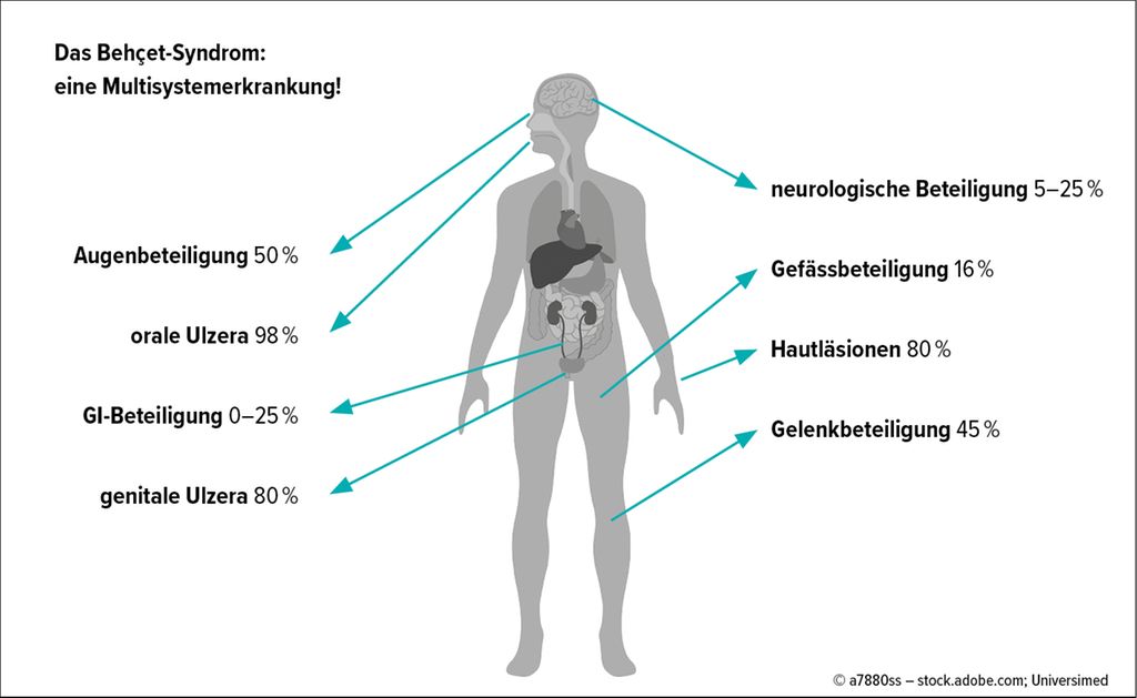 Morbus Behçet Symptome Bei Frauen www.universimed.at